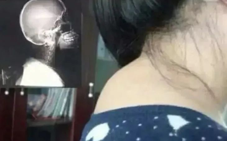 “富贵包”的解剖结构及治疗方法