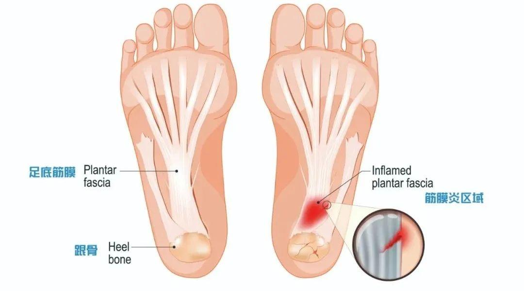 康复师要知道的足底筋膜炎的诊断与治疗方法