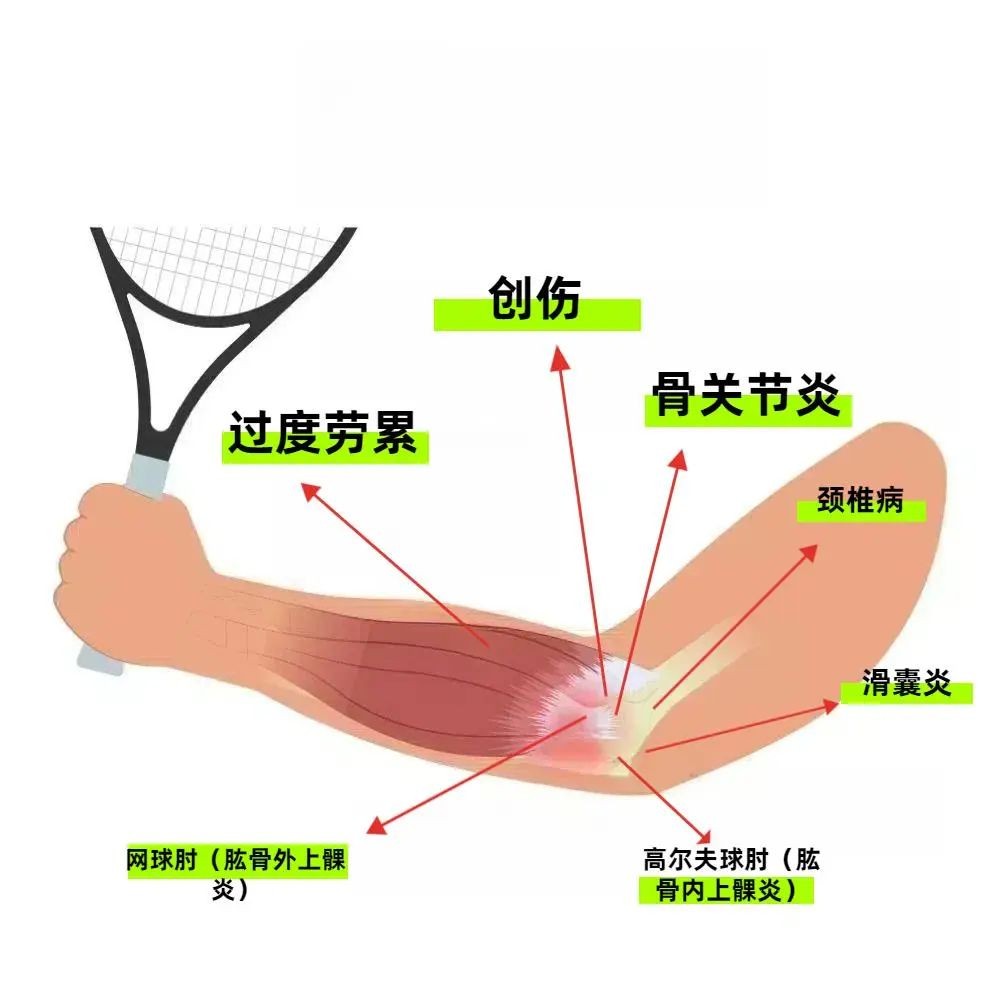 肱骨外上髁炎（网球肘）的症状和治疗
